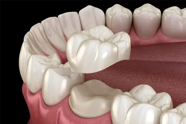  A 3D rendering of a crown being placeed 