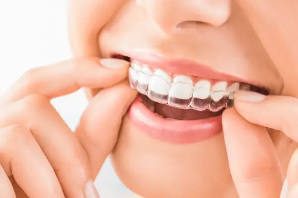  A woman placing an invisalign clear aligner in their mouth